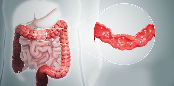 Những dấu hiệu viêm đại tràng không nên bỏ qua 